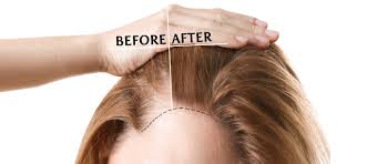 Hair Transplant